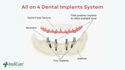 All on 4 Dental Implants System